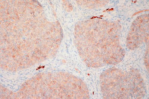 Granulosa Cell Tumor of the Ovary, Inhibin Immunostain